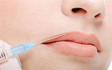 海南微整祛嘴角纹能维持多久？